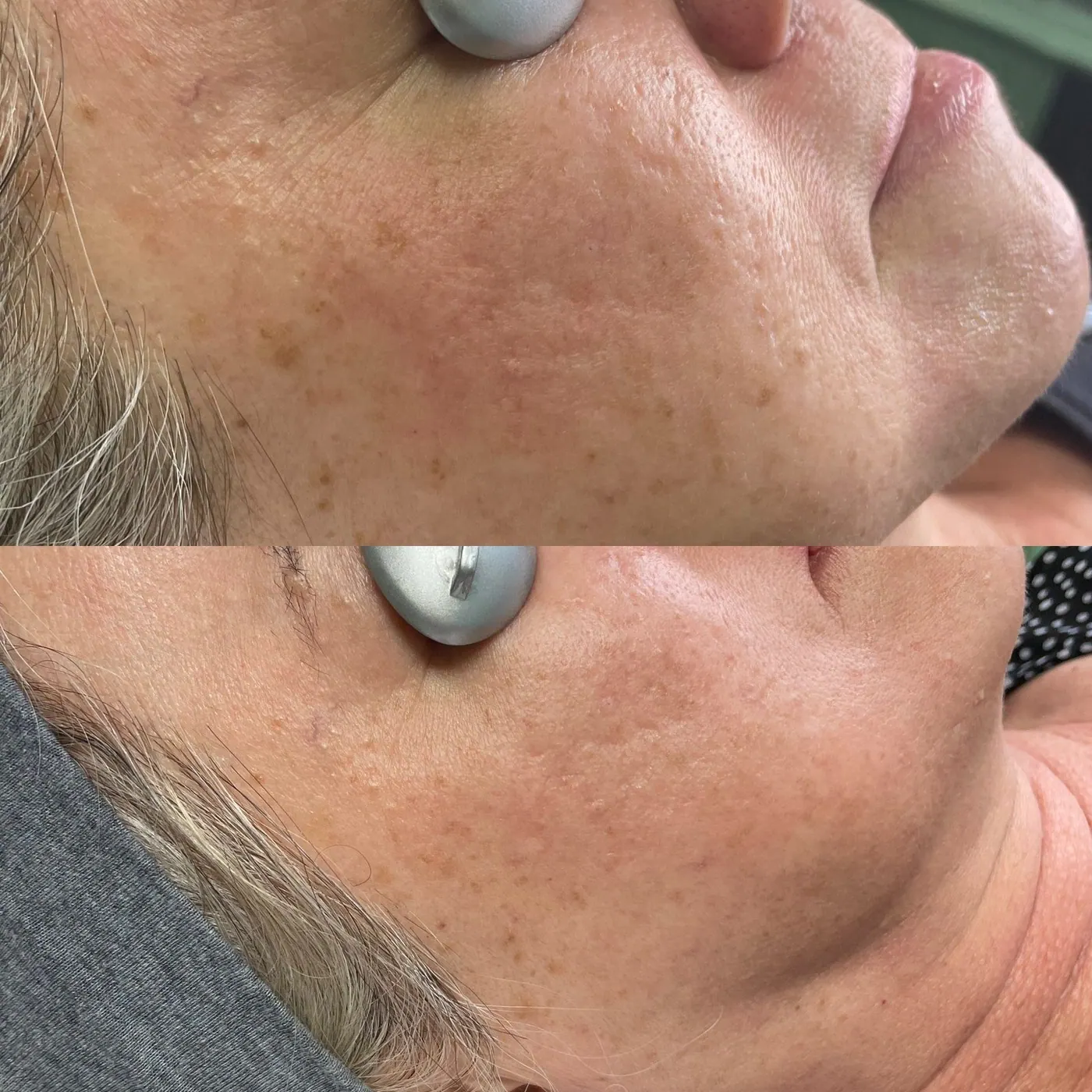 Close-up of a woman's cheek before and after skincare treatment showing reduced pigmentation and improved skin texture.
