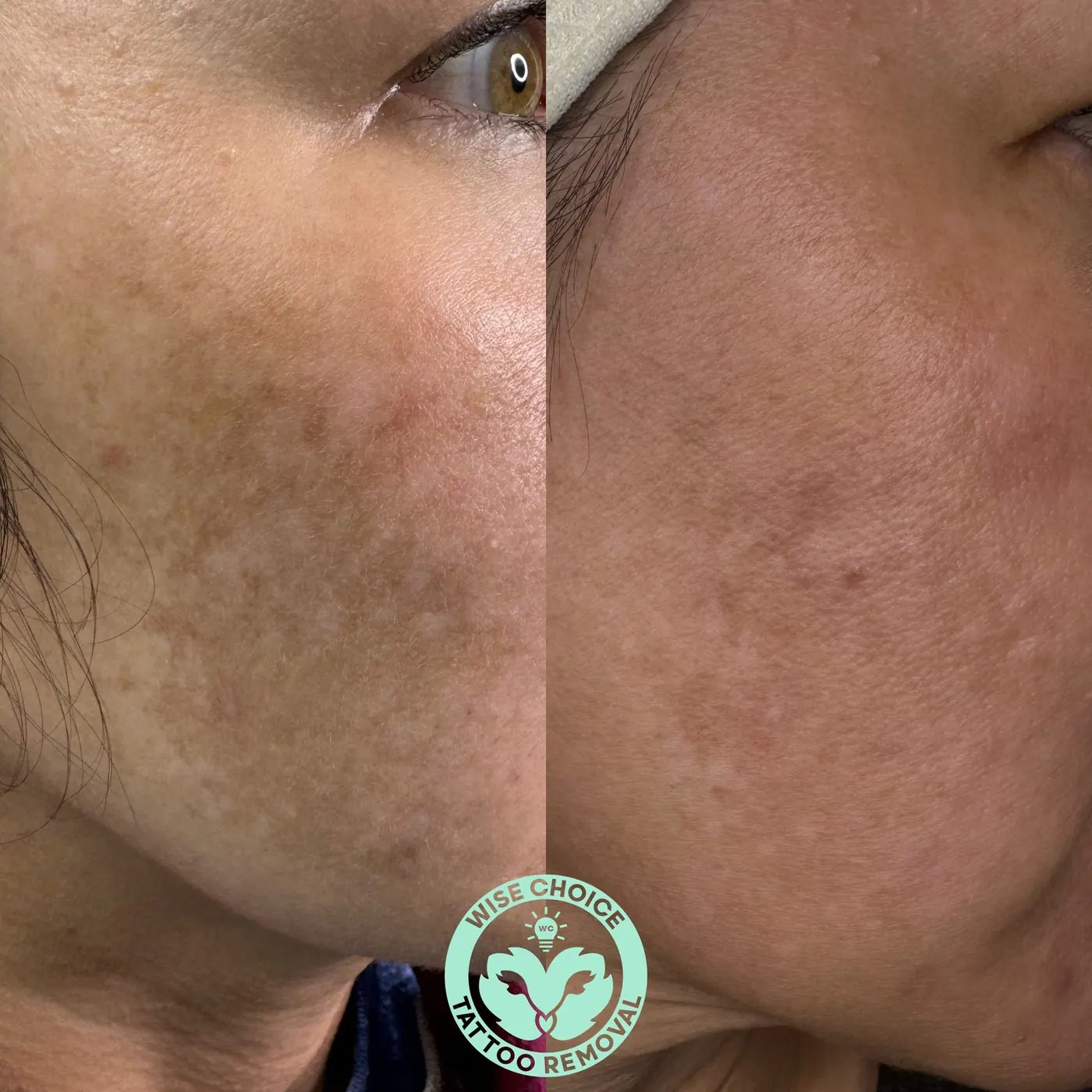 A side-by-side comparison of a person's cheek, showing the face before and after tattoo removal, with visible improvement and less pigmentation in the after image, and a logo at the bottom reading "Wise Choice Tattoo Removal".
