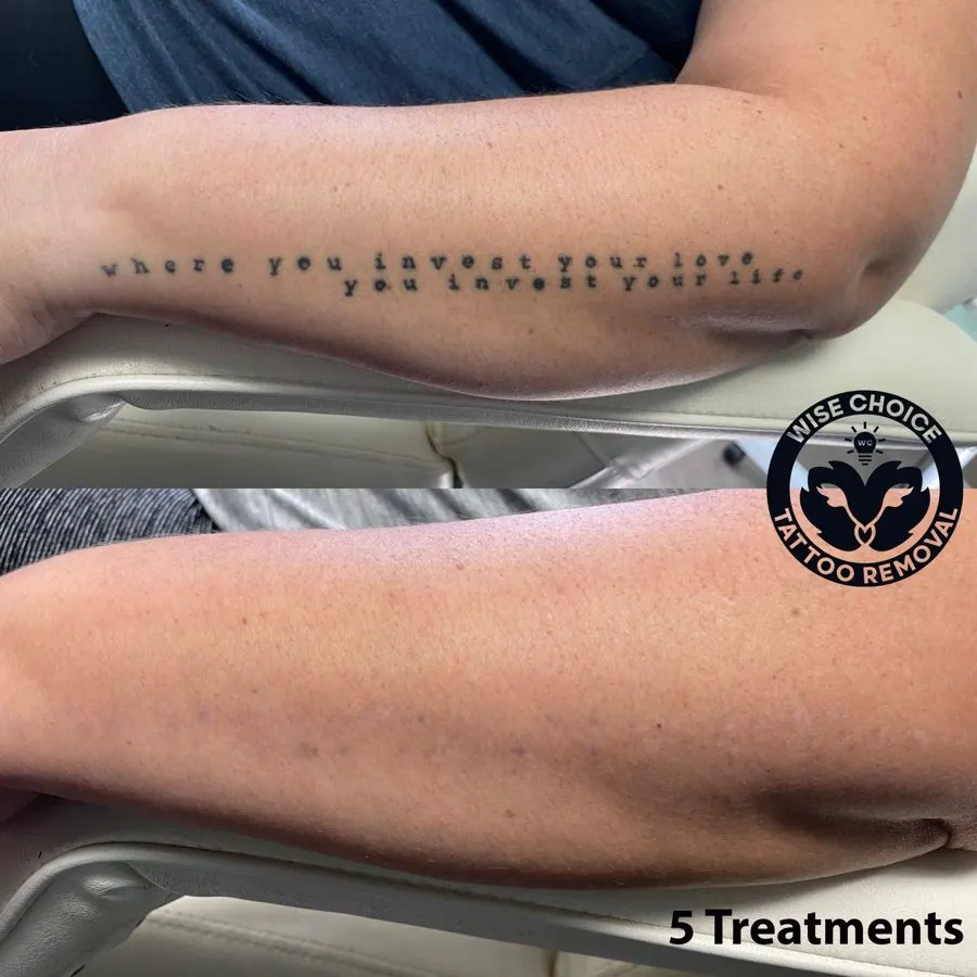 Before and after images of a tattoo removal process on a person's forearm. The first image shows a black tattoo that reads 'where you invest your love, you invest your life.' The second image shows the same forearm after five tattoo removal treatment