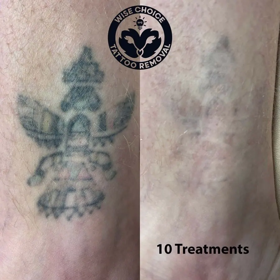 Side-by-side comparison of a tattoo before and after 10 tattoo removal treatments, showing significant fading on the right side.