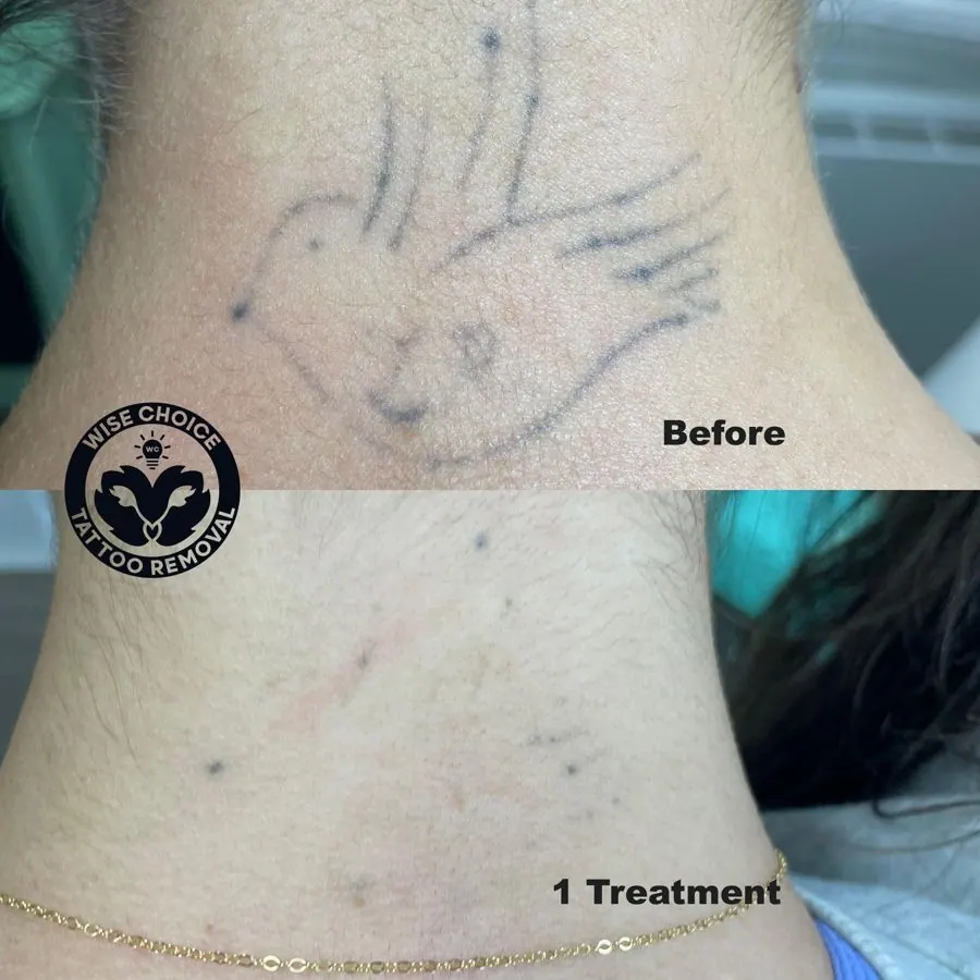 Close-up of a person's neck showing a tattoo before and after tattoo removal treatment, with the phrase '1 Treatment' under the bottom image.