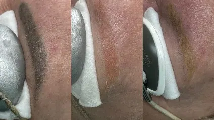 Your Guide to Permanent Makeup Removal