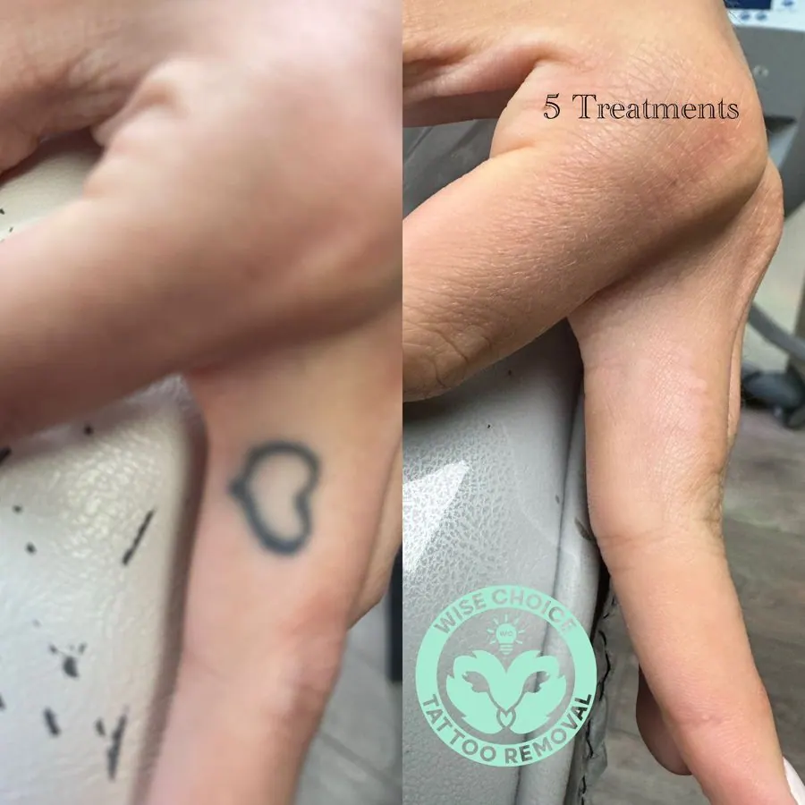 Comparison of a small, black, outlined tattoo on the finger before and after removal. The tattoo is a simple, irregular shape, and the skin appears smoother and tattoo-free after five treatments.