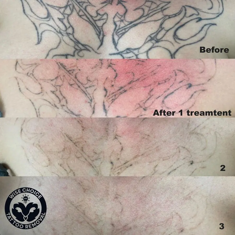 Progression of tattoo removal on skin, showing four stages: initial tattoo, after one treatment with redness, after second treatment with faded lines, and near total removal with faint traces.