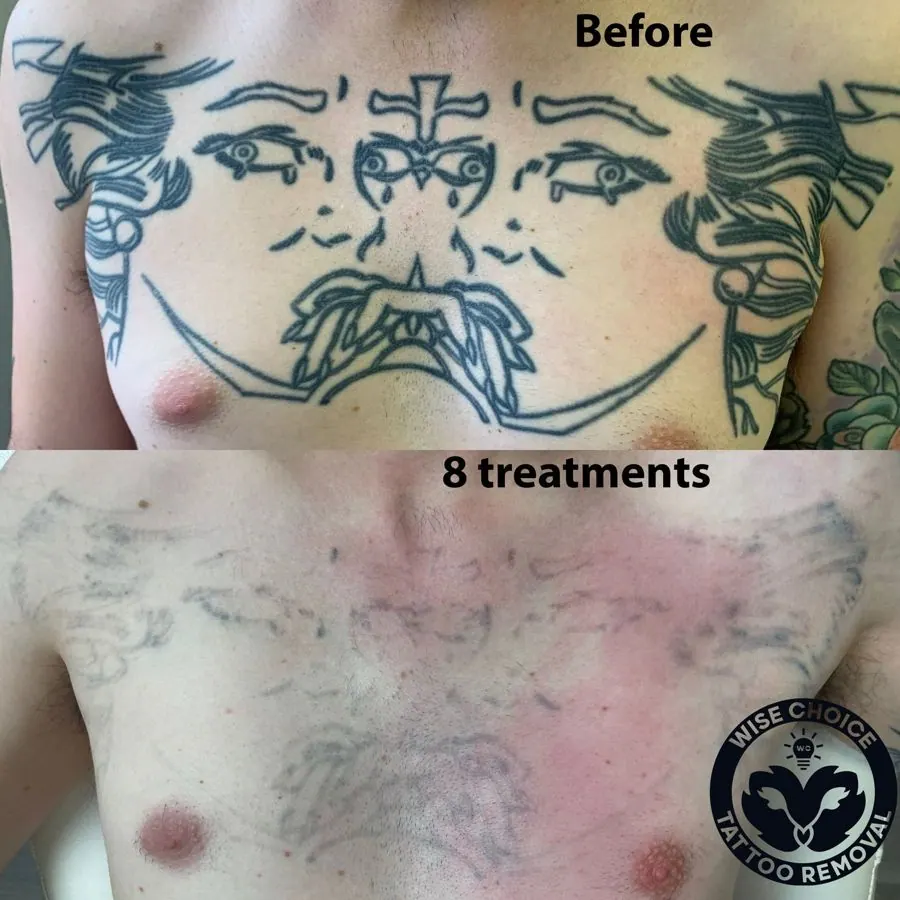 Comparison of a man's chest before and after 8 tattoo removal treatments showing faded tattoo and scar tissue