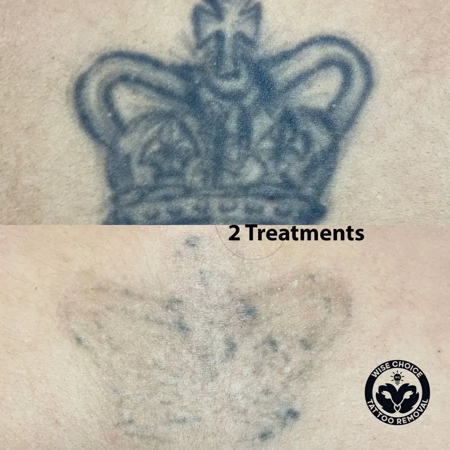 Comparison of tattoo before and after 2 treatments. The top image shows a dark, detailed tattoo of a crown on skin. The bottom image shows the same area with significantly faded tattoo. The bottom right corner has a circular logo reading 'Wise Choice