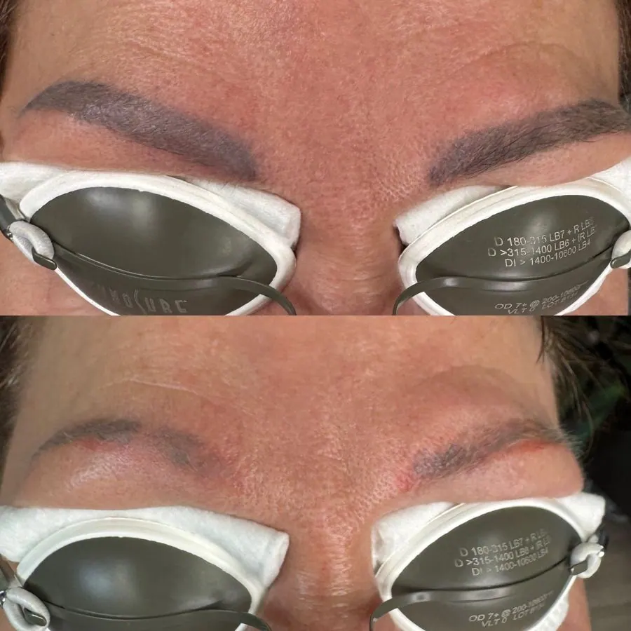 Close-up of a person's forehead and eyebrows, with two different skincare or cosmetic treatments visible in two sections of the image, with the person wearing eye pads or goggles.