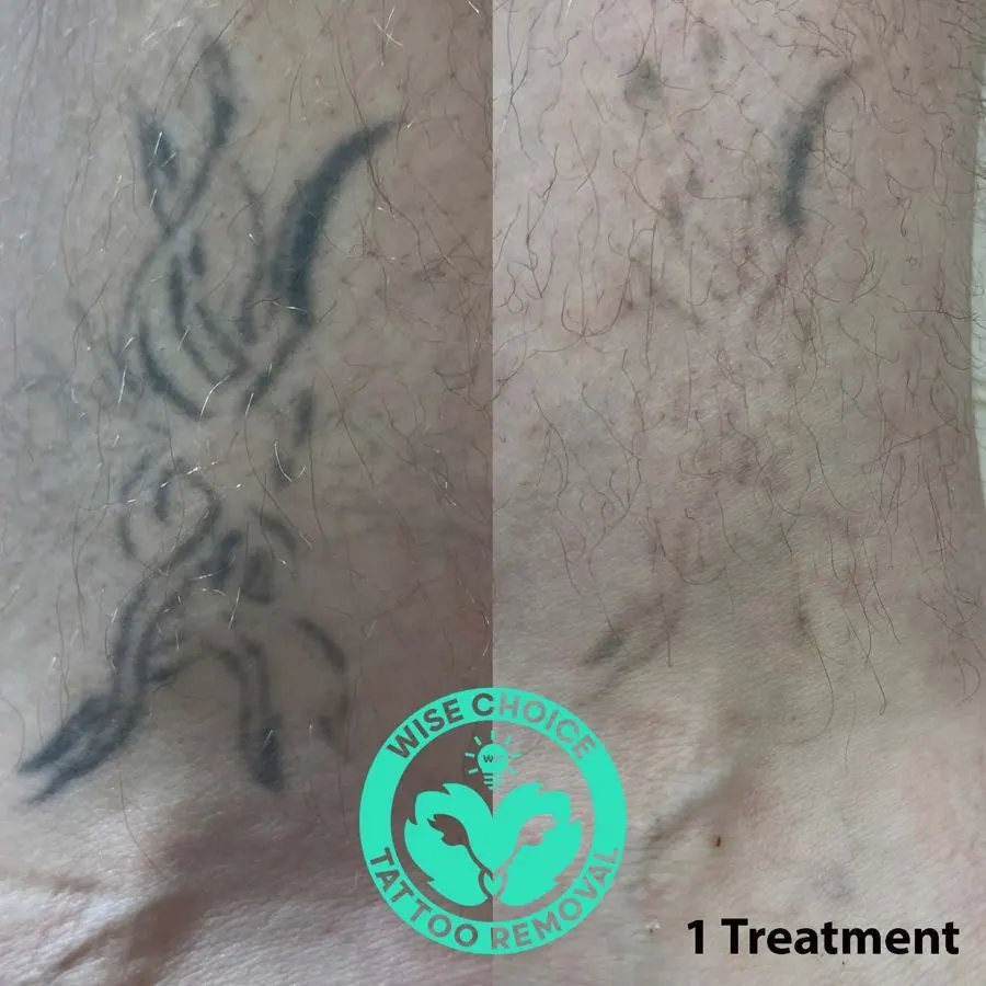 Close-up of a person's skin with a tattoo on the left side and tattoo removal on the right side, showing difference after one treatment