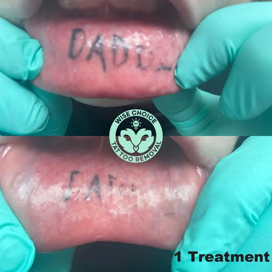 Close-up of a person's tongue showing a tattoo of the word 'DAD' before and after one tattoo removal treatment, with a logo for 'Wise Choice Tattoo Removal' in the center and the text '1 Treatment' in the lower right corner.