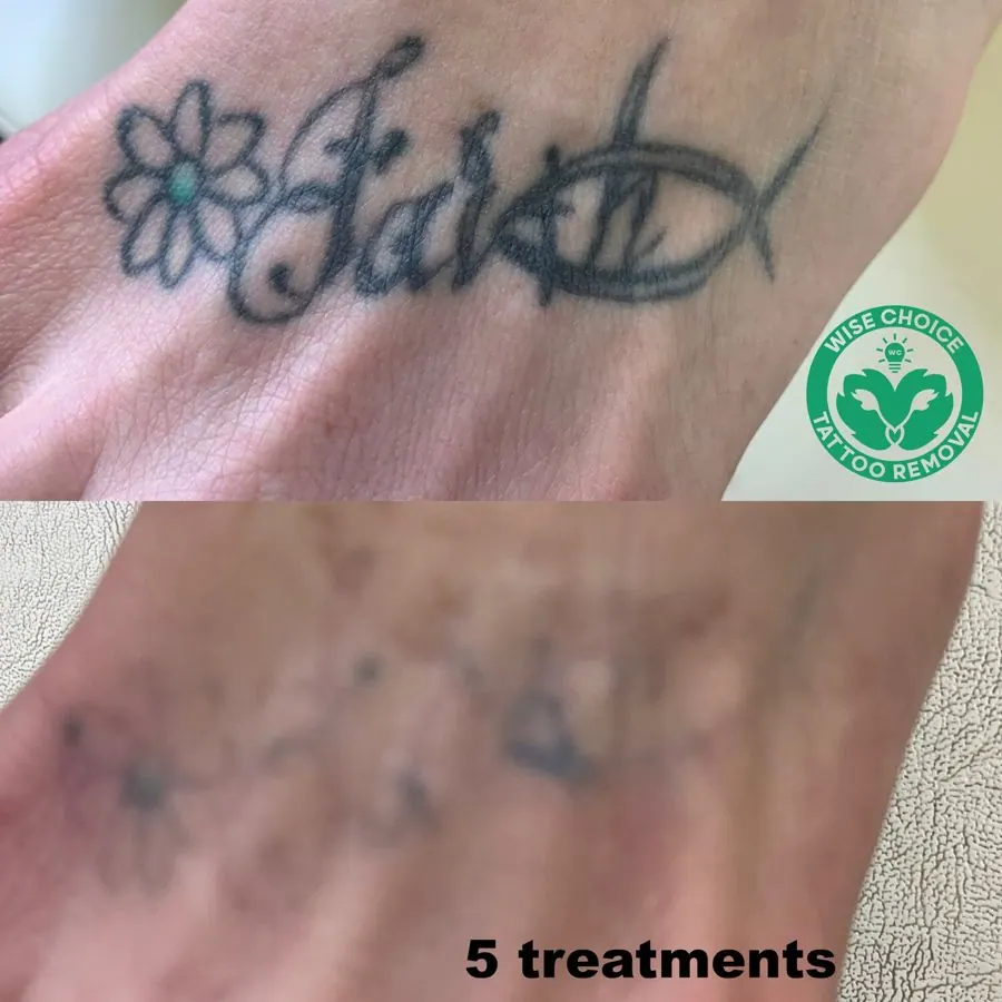Comparison of a tattoo before and after five tattoo removal treatments. The top image shows a clear, defined tattoo with a flower and script design, while the bottom image shows the same area after five treatments, with faded and blurred tattoo ink.