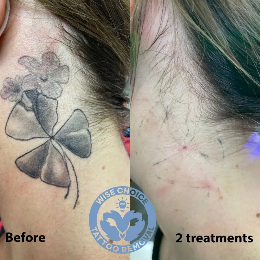 Close-up comparison of a person's skin before and after tattoo removal. The left side shows a butterfly and flower tattoo, and the right side shows the same area with the tattoo faded after two treatments. The logo for Wise Choice Tattoo Removal is a