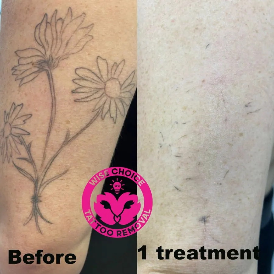 Side-by-side comparison of a tattoo on a person's arm before and after a tattoo removal treatment. The 'before' shows a tattoo of daisies, and the 'after' shows fading and removal of the tattoo ink. The image includes a pink logo for wise choice tatt