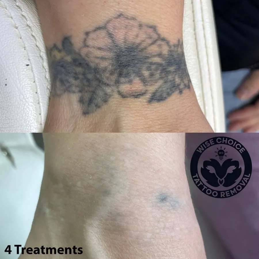 Before and after images showing the removal of a tattoo with four treatments, with a small tattoo of two swans on the lower right side of the skin.