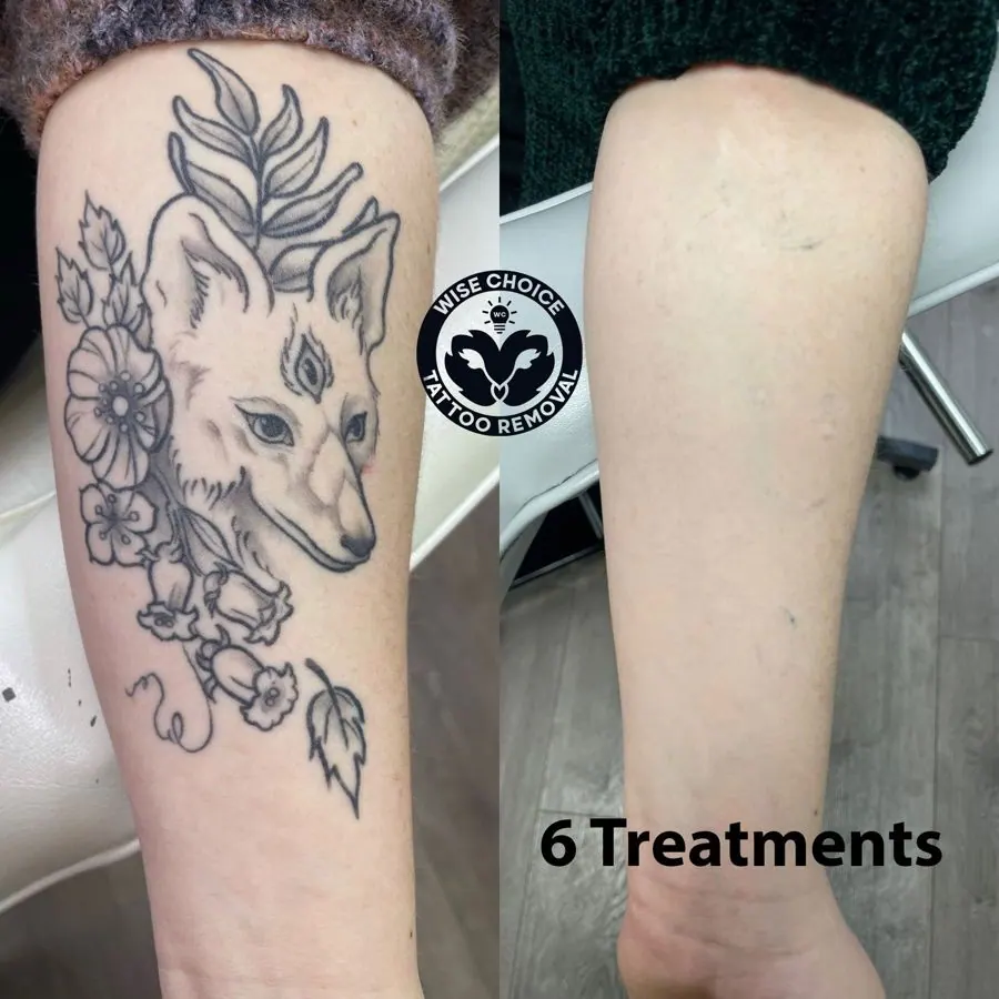 Tattoo removal progression showing a fox and floral tattoo on a person's inner forearm, with the second image indicating the tattoo has been significantly faded after 6 treatments.