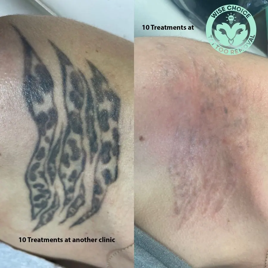 Comparison of tattoo removal progress with two close-up images of skin, showing a tattoo on the left that has undergone 10 treatments at a different clinic and a less healed area on the right after 10 treatments with Wise Choice TATtoo Removal, indic
