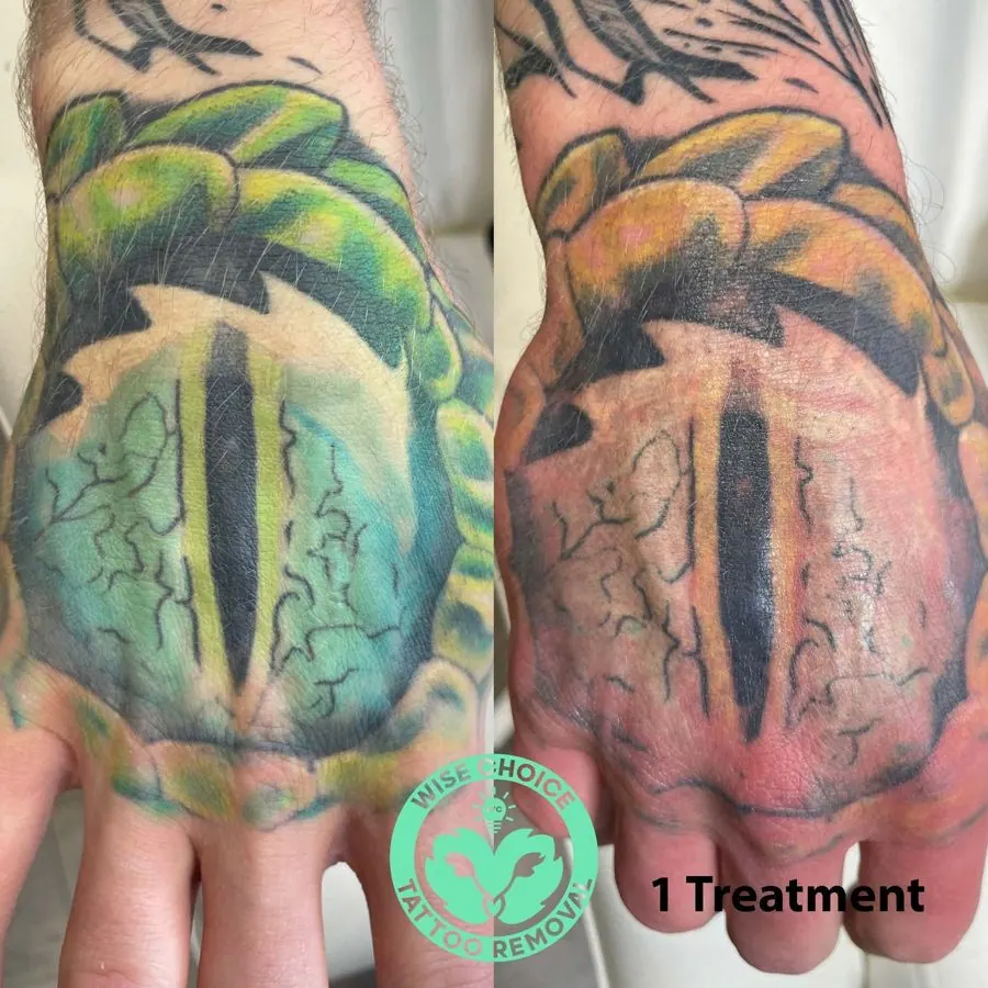 Comparison of a tattoo on a person's hand before and after one tattoo removal treatment. The tattoo features a stylized eye design with green and orange color variations and black outlines. The after image shows fading and lightening of the tattoo.