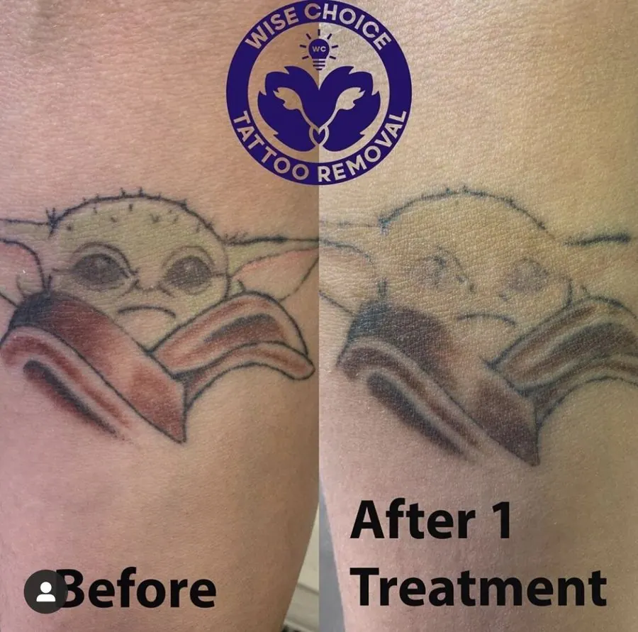 Comparison image showing a tattoo before and after tattoo removal treatment. The tattoo depicts a cartoon character with large eyes and a tongue sticking out. The 'before' side shows the tattoo clearly, while the 'after' side shows it significantly f