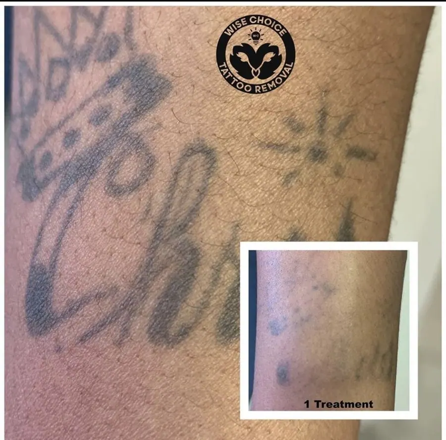 Close-up of a tattoo on skin showing fading after one tattoo removal treatment.