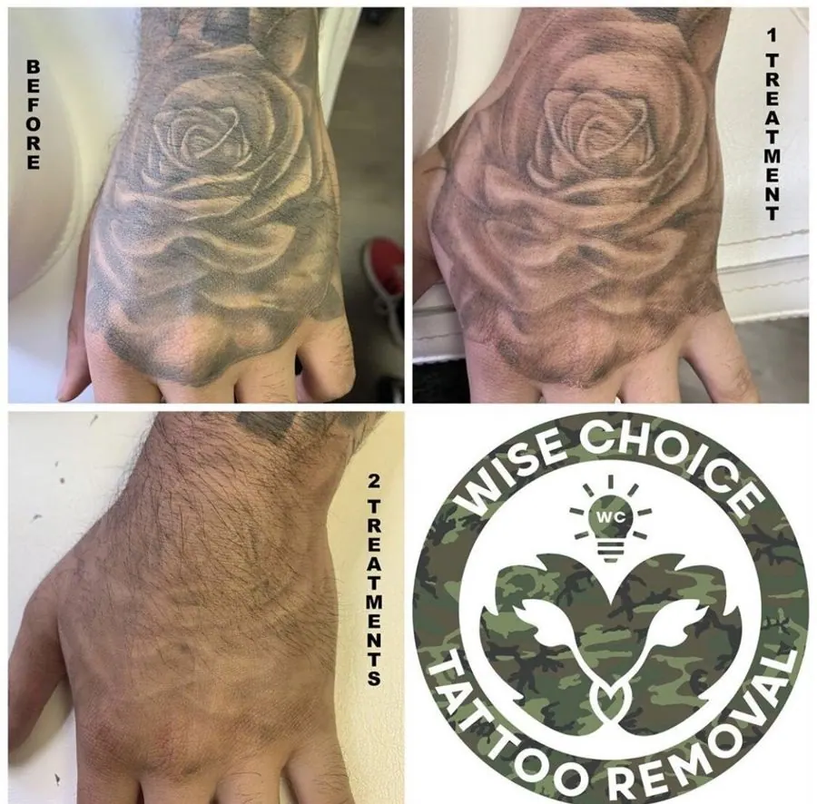 Three photos showing a tattoo removal process. The first photo shows a tattoo of a rose on a hand before removal. The second photo shows the same rose tattoo after one treatment, with faded ink. The third photo shows the hand after two treatments, wi