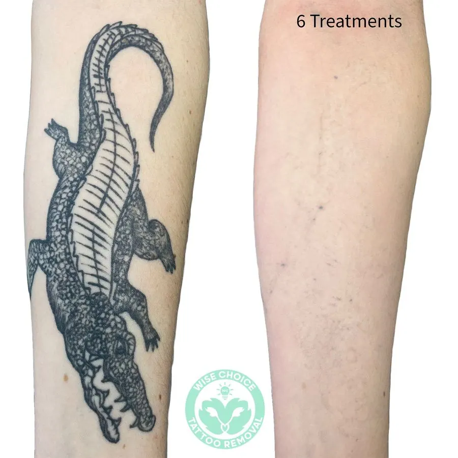 Comparison of a person's arm before and after six tattoo removal treatments, with a crocodile tattoo on the left arm and no visible tattoo on the right arm, and the text '6 Treatments'.