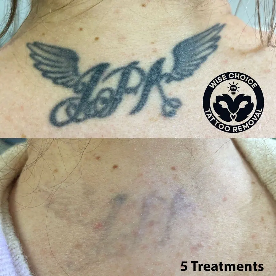 Tattoo on upper chest with wings and stylized text, and close-up of skin with five treatment marks indicating tattoo removal progress.