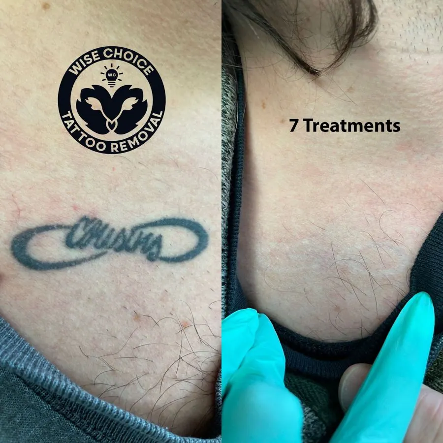 Before and after images of a tattoo removal process on a person's chest, showing a tattoo that reads "Chyna" on the left and the skin after 7 treatments on the right, with a hand wearing a blue glove pointing at the treated area.