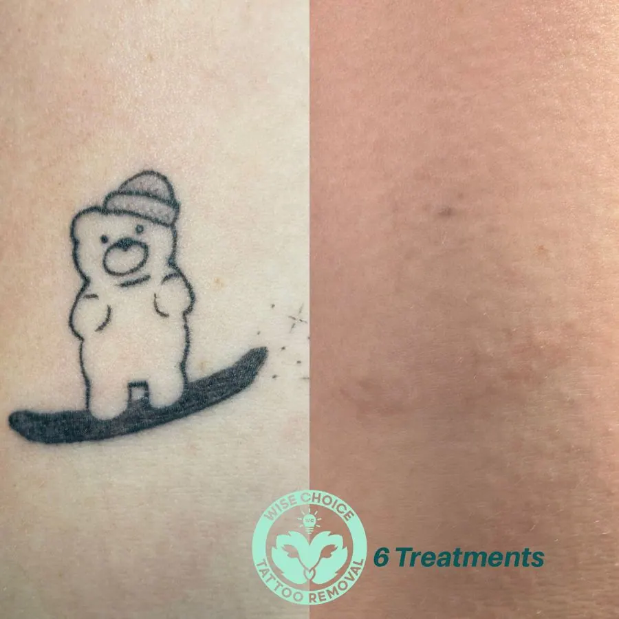 Tattoo removal progress showing a teddy bear flying on a snowboard on the left side and the skin after six treatments on the right side.