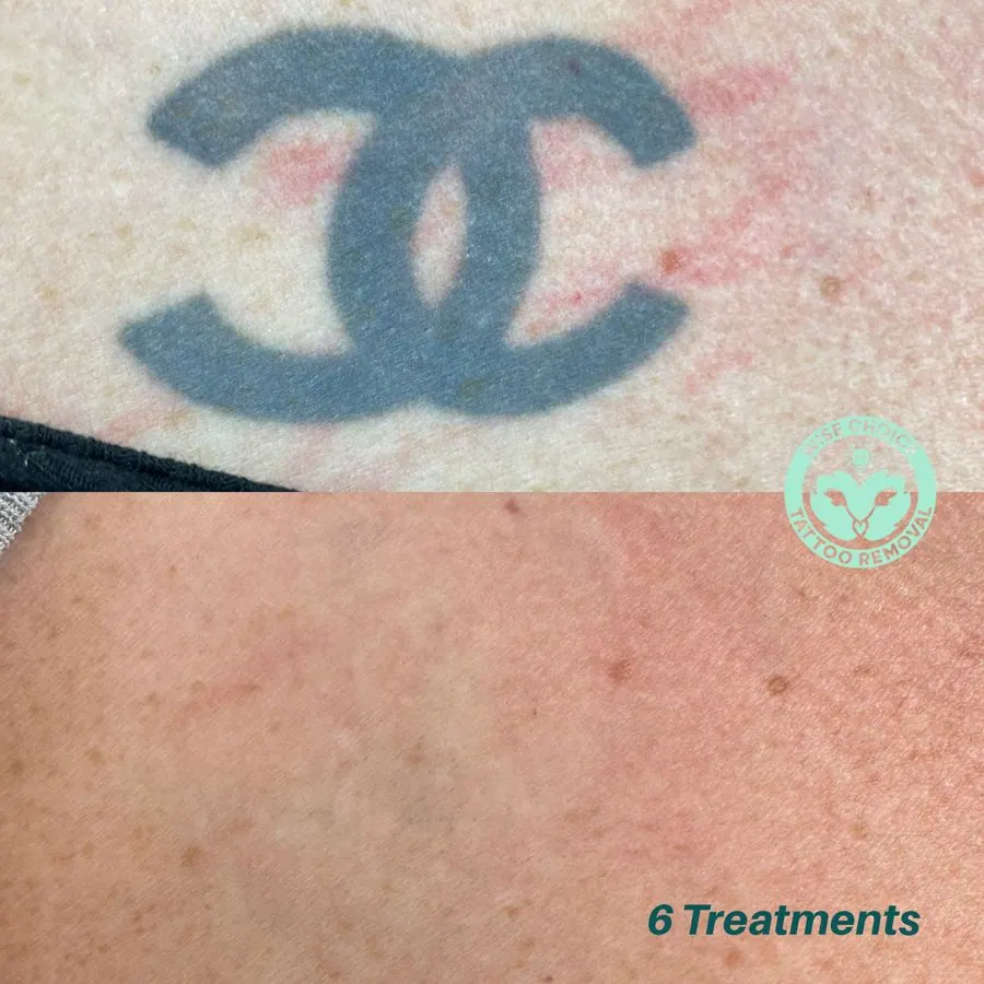 Before and after images showing tattoo removal process, with the tattoo fading after six treatments, featuring a Chanel logo tattoo.