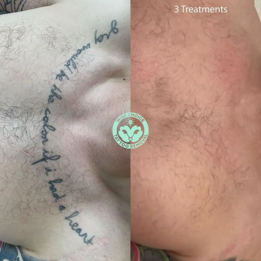 A before-and-after comparison of tattoo removal, showing tattoo removal on a male chest, left side, and the same area with no visible tattoo and lighter skin on the right side, indicating three treatments at a tattoo removal clinic.