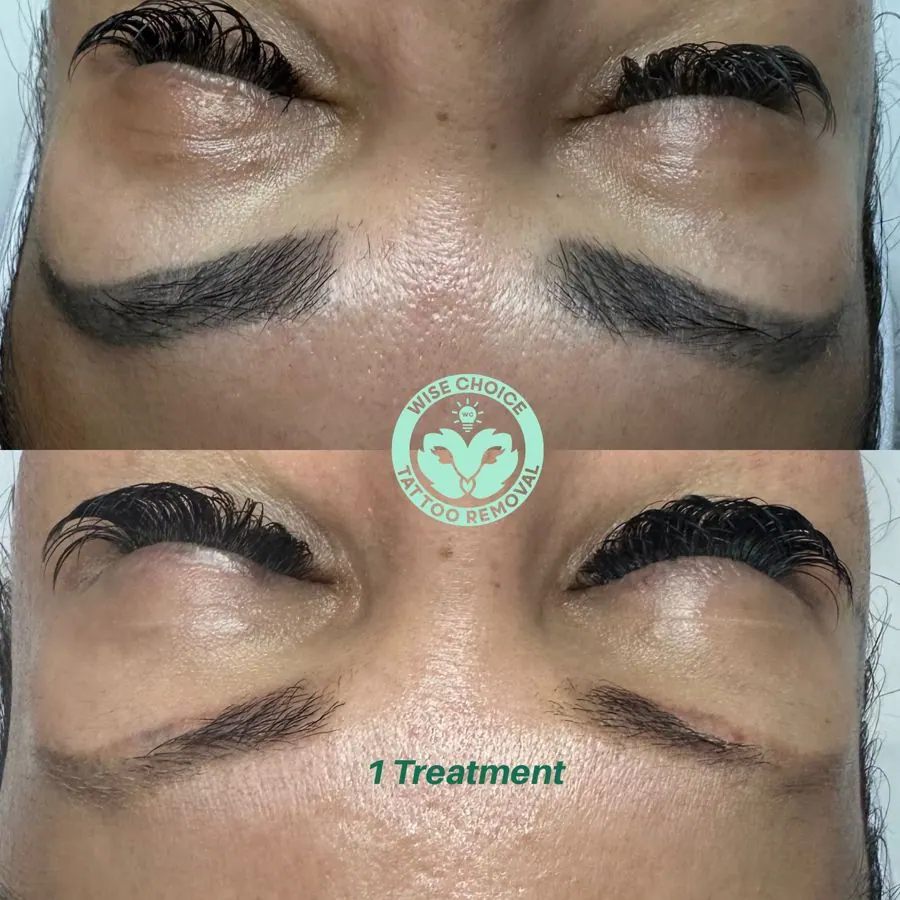 Before and after images of a person's eyebrows showing tattoo removal, with the after image labeled '1 Treatment' and a logo that says 'Wise Choice Tattoo Removal' in the center.