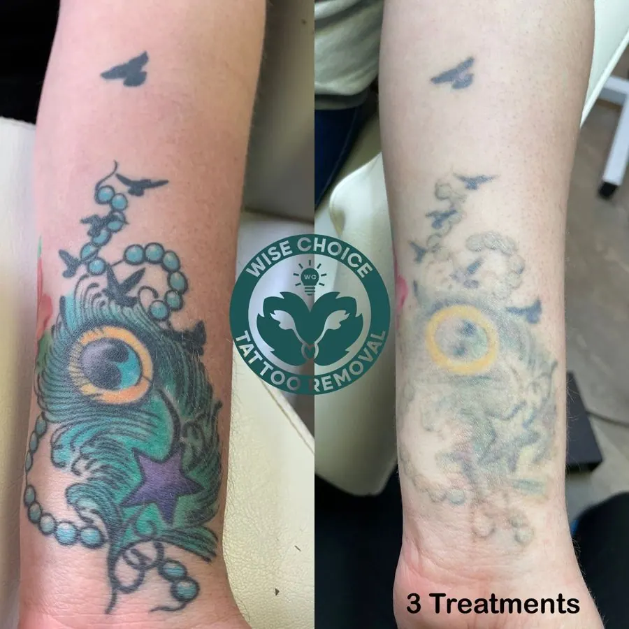 Comparison of a colorful peacock tattoo on an arm before and after 3 tattoo removal treatments, with fading and lightening of the ink.