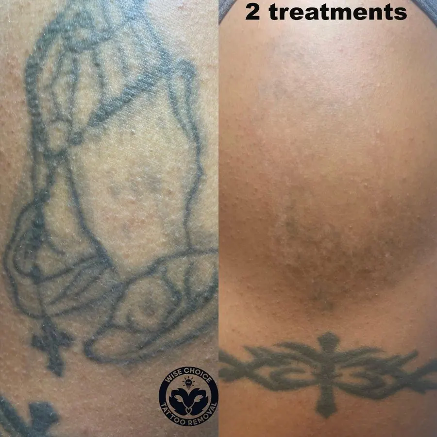 Side-by-side comparison of a tattoo before and after two treatments, showing the tattoo fading significantly after treatments.