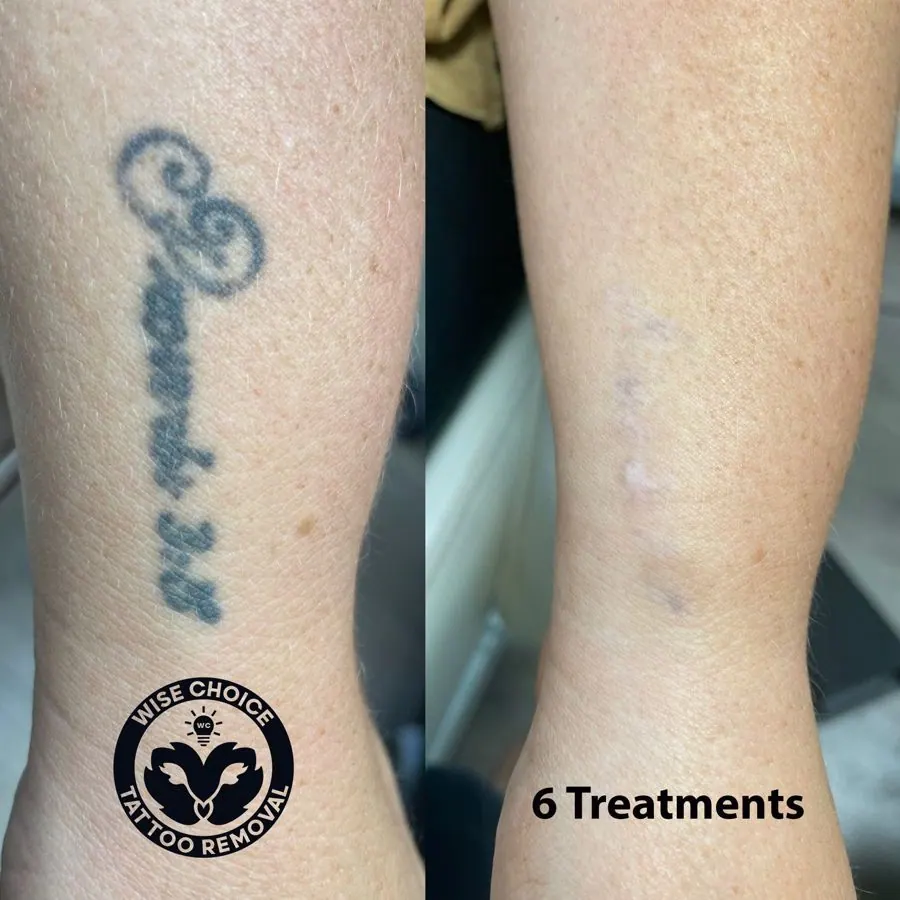Comparison of a tattoo on a person's skin before and after 6 tattoo removal treatments. The left side shows a faded, blurry tattoo, while the right side shows significantly lighter skin with the tattoo nearly gone.
