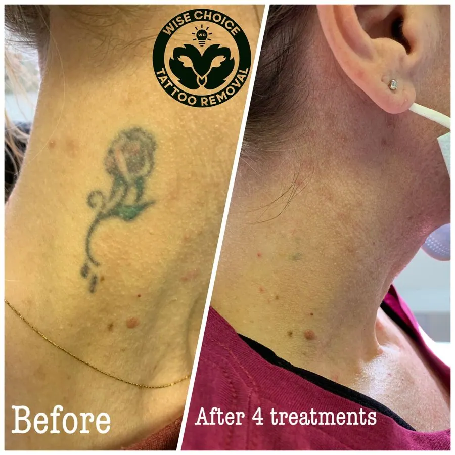 Comparison photo showing a tattoo on a person's neck before and after four tattoo removal treatments. The left side shows a blurred tattoo of a rose with some dots and a delicate gold necklace, labeled 'Before'. The right side shows the same area aft