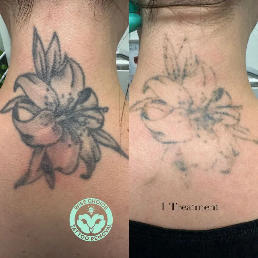 Comparison of a floral tattoo on a person's neck before and after laser tattoo removal treatment, showing fading of the tattoo after one session.