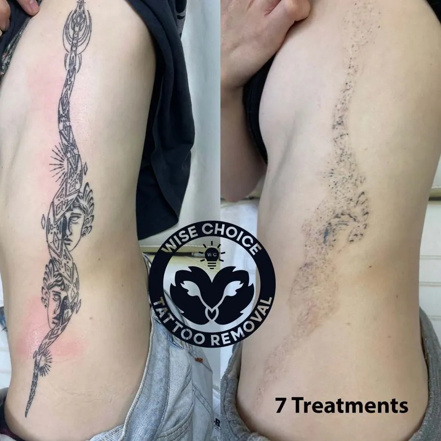 Side-by-side comparison of a person's upper arm and side after tattoo removal treatments, showing numerous treatments and fading tattoo.