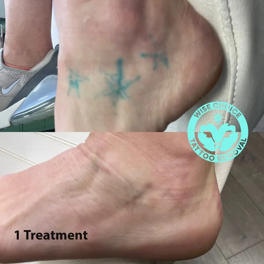 Before and after tattoo removal of a star-shaped tattoo on ankle, showing faded tattoo after one treatment.