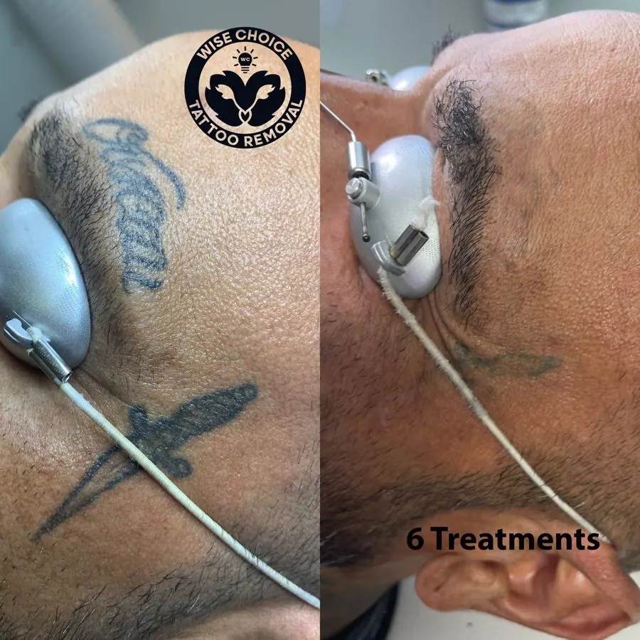 Comparison of tattoo removal process on a person's side of face and neck with a logo for Wise Choice Tattoo Removal and text indicating six treatments.