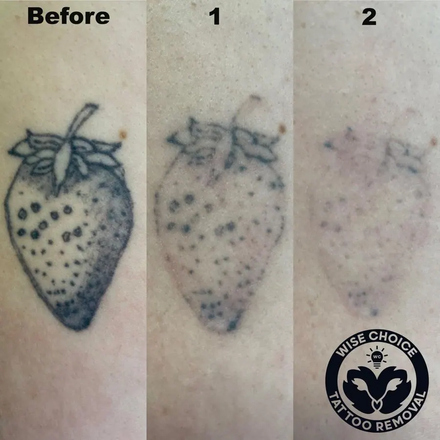 Comparison of a strawberry tattoo before, during, and after removal process.