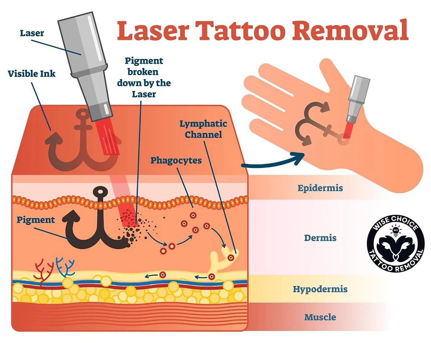 laser tattoo removal