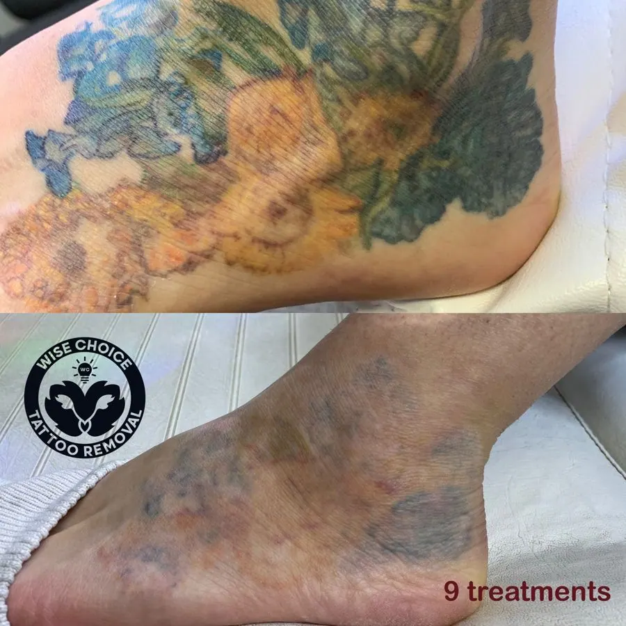 Before and after images of a tattoo removal process on a person's ankle, showing a faded tattoo after 9 treatments.