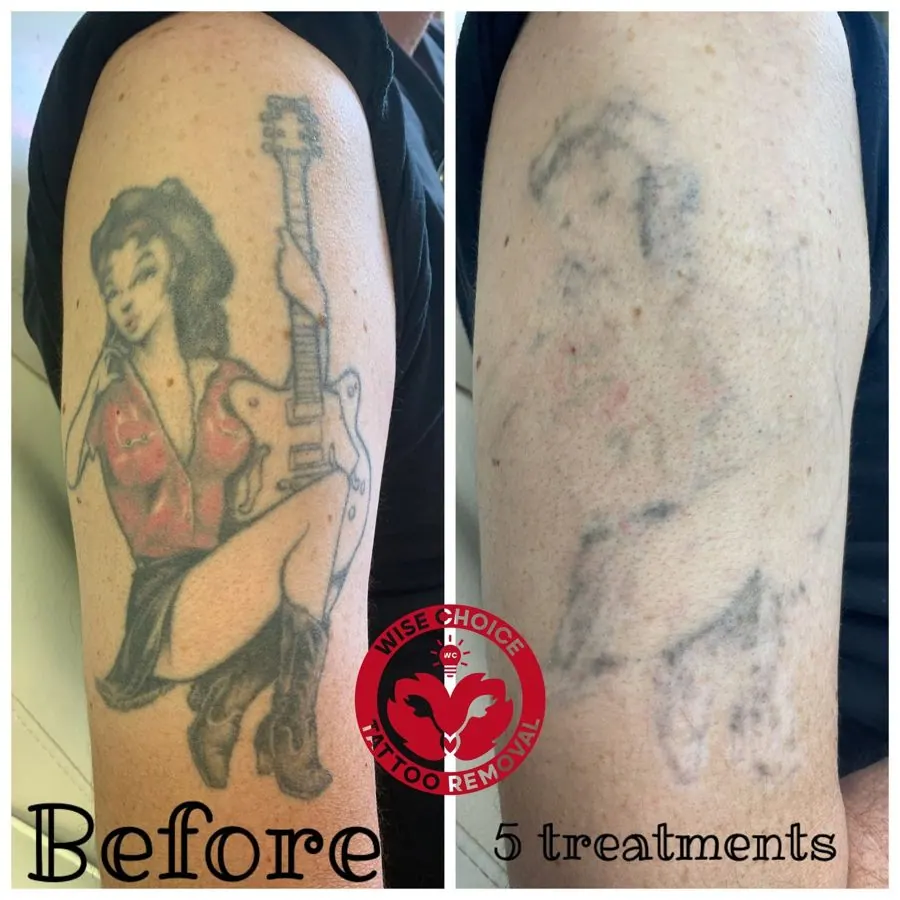 Tattoo removal before and after images showing a woman's upper arm with a pin-up girl tattoo on the left side, and the faded tattoo on the right side after five treatments.