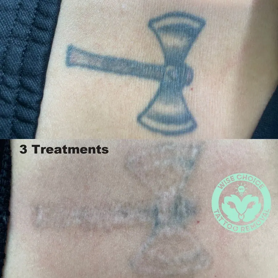 Tattoo removal process showing a tattoo of a hammer with a dollar sign in a two-part before-and-after comparison, with a logo on the bottom right corner for a tattoo removal service.
